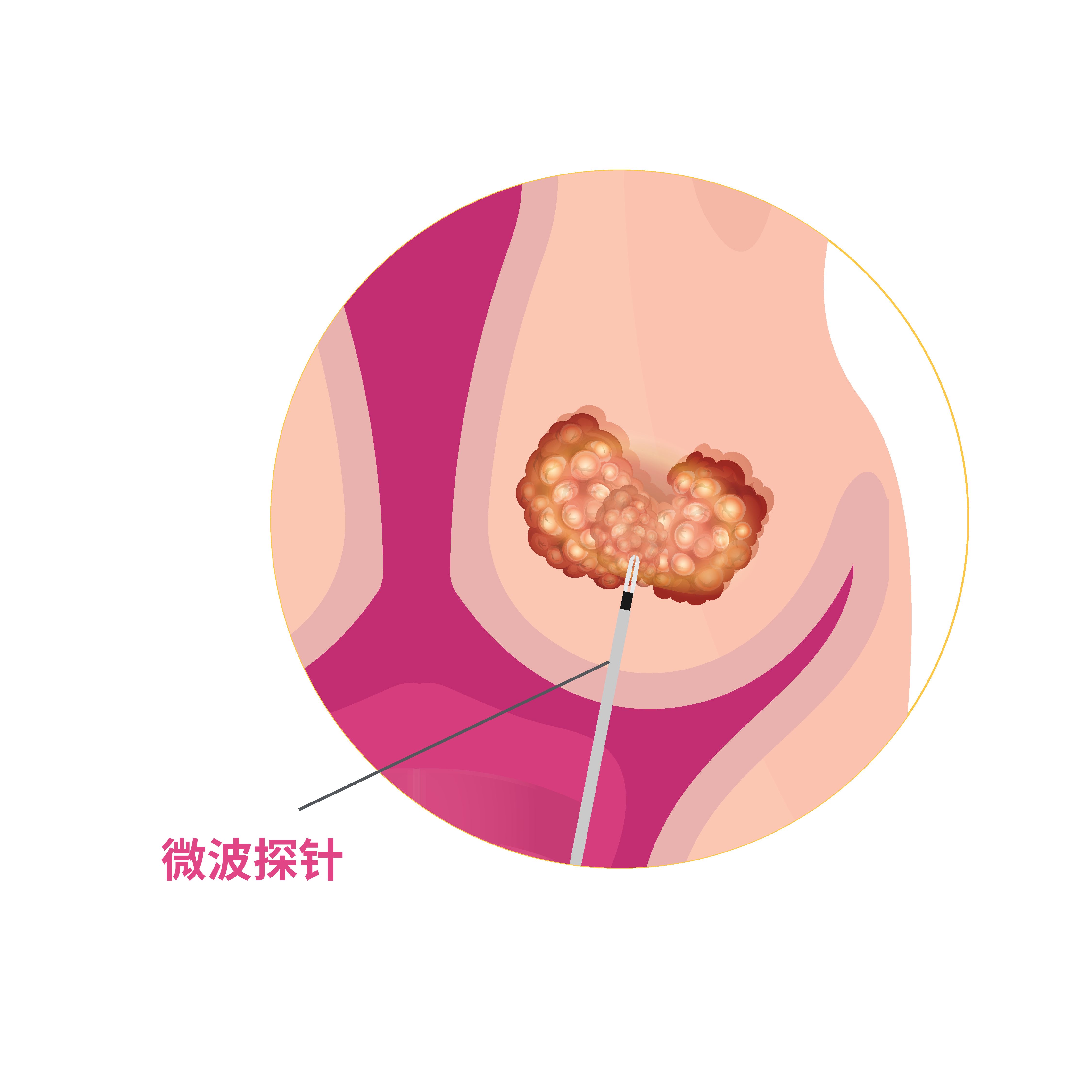 Probe insertion for Microwave Ablation