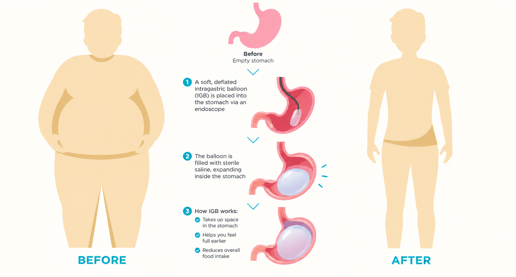 Intragastric Balloon (IGB)