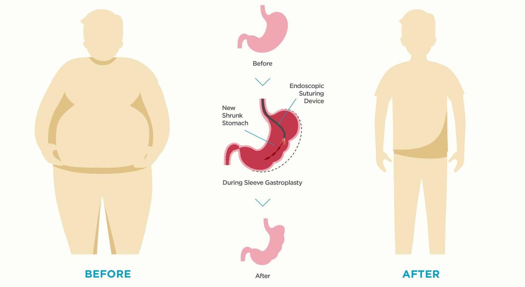 Endoscopic Sleeve Gastroplasty (ESG)