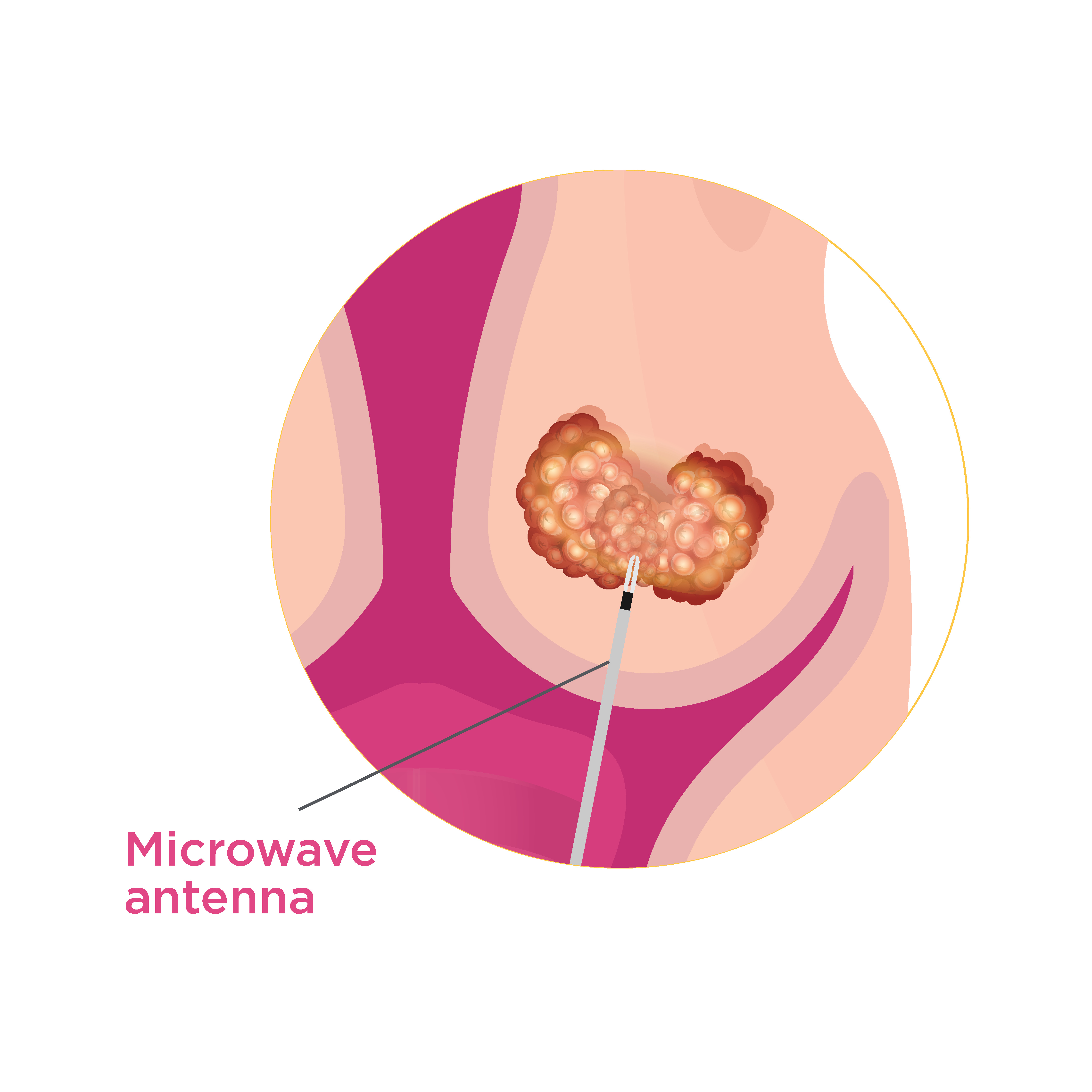 Probe insertion for Microwave Ablation