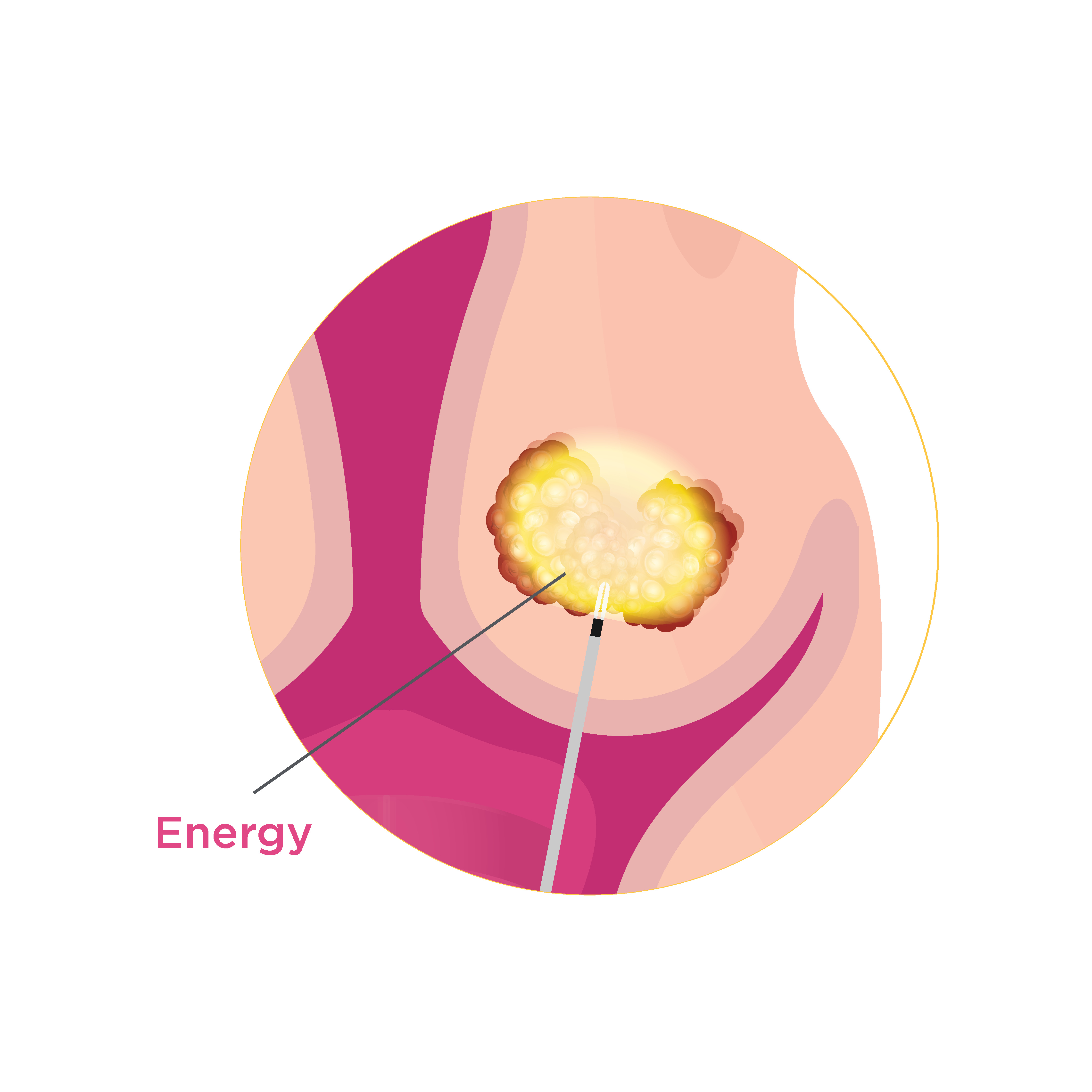 Microwave energy delivery